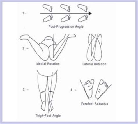 tibial torsion normal range